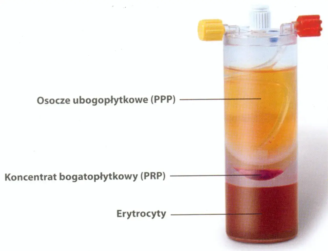 Probówka z rozwarstwionym osoczem: osocze ubogopłytkowe (PPP), koncentrat bogatopłytkowy (PRP) i erytrocyty.