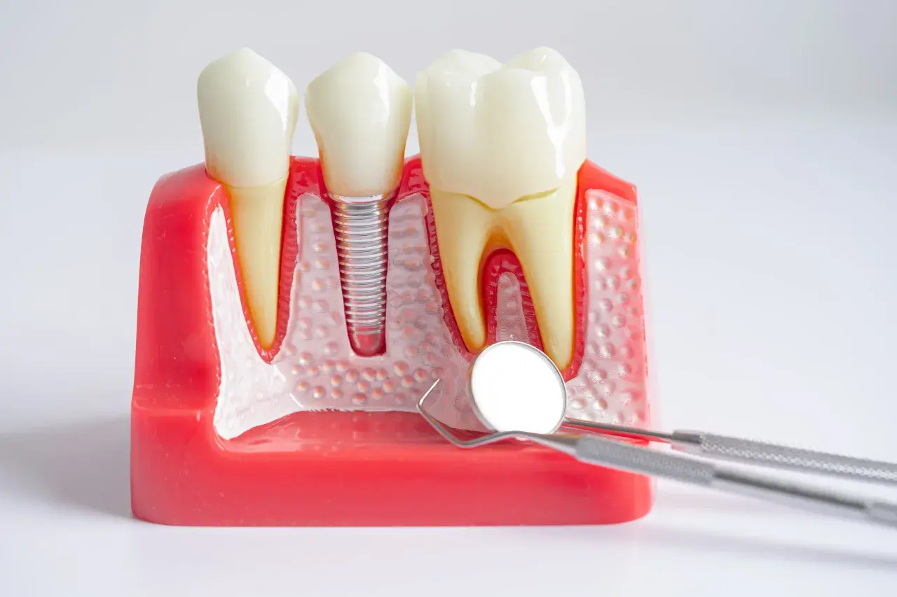 Modello dentale con impianto: anche con la piorrea si possono mettere i denti fissi. Strumenti dentistici in primo piano.