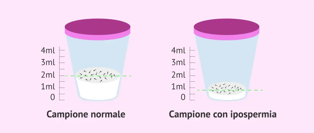 Confronto tra campione normale e ipospermia. La curiosità quando un uomo non viene, mostra una ridotta quantità di spermatozoi.