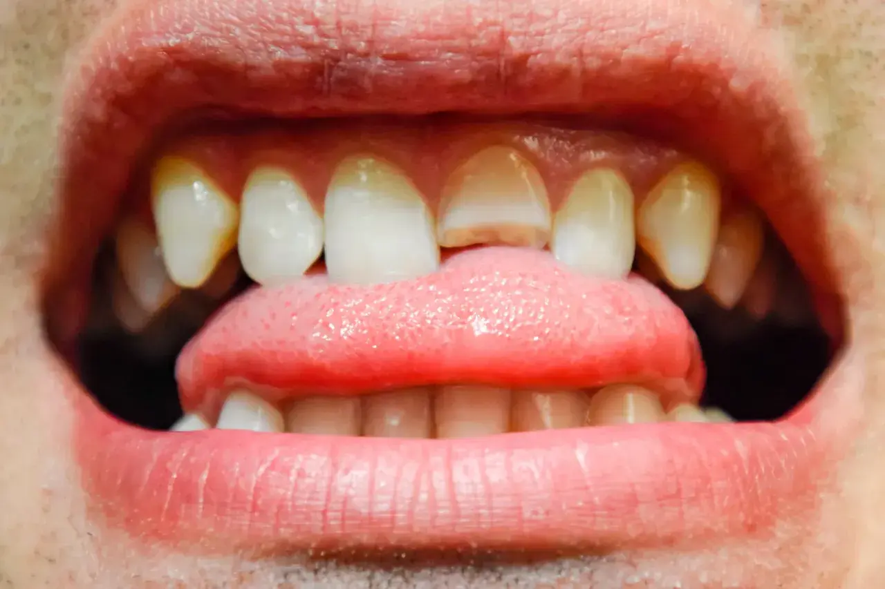 Primer plano de una boca abierta mostrando dientes delanteros con grietas visibles y una lengua rosada.