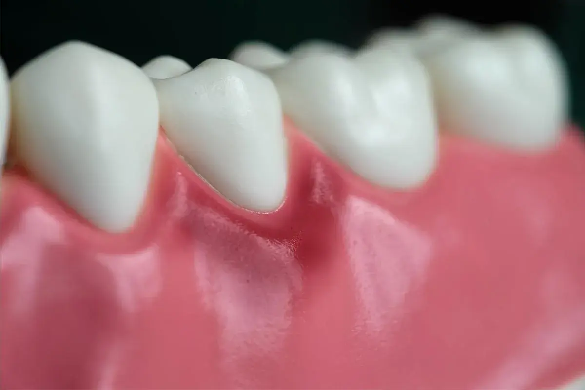 Detalle de dientes y encías, mostrando una leve inflamación en la encía de una muela.