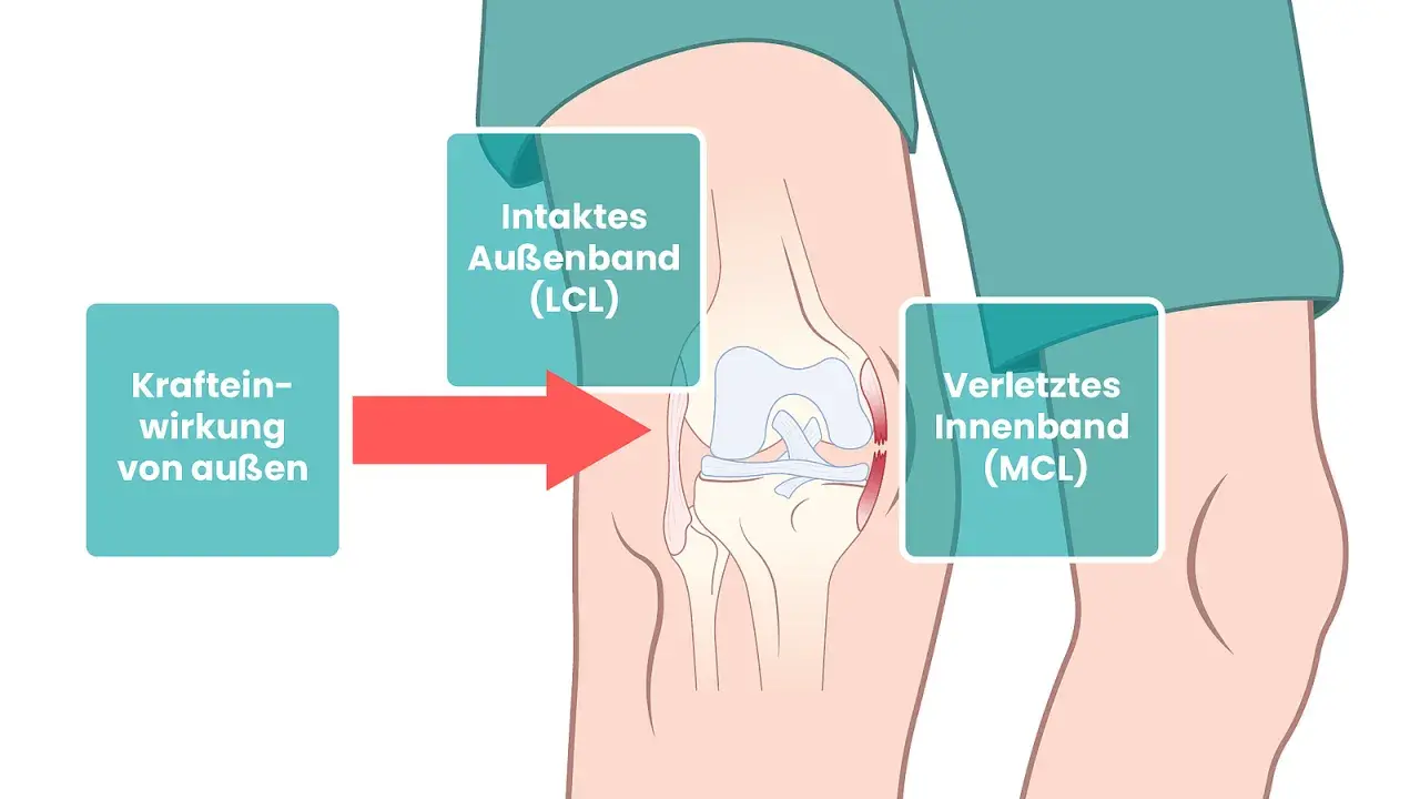 Schema zeigt Kniegelenk mit Kraftwirkung von außen, die zu einem verletzten Innenband (MCL) führt.