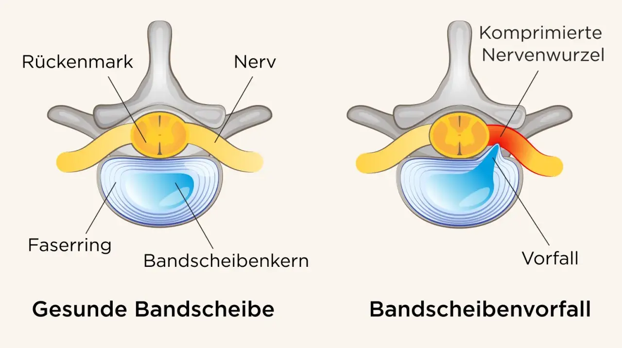 Vergleich gesunde Bandscheibe vs. Bandscheibenvorfall. Ein Vorfall drückt auf Nerven, was zu quälenden Bandscheibenvorfall Schmerzen gehen nicht weg führen kann.