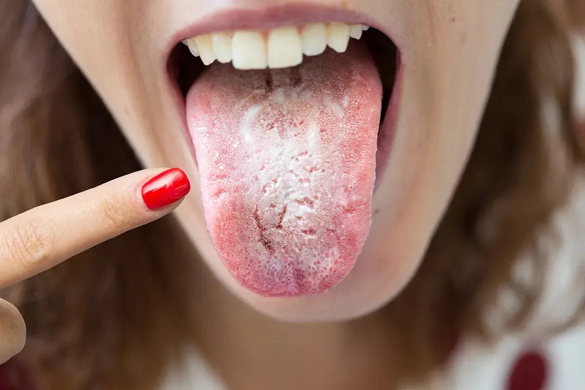 Una persona se señala la lengua, que se ve blanca y con una textura áspera y seca, indicando posible candidiasis oral.
