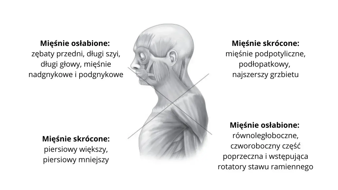 Anatomia głowy i szyi z zaznaczonymi mięśniami. Wskazano mięśnie osłabione, w tym mięśnie nadgnykowe i podgnykowe, oraz skrócone.
