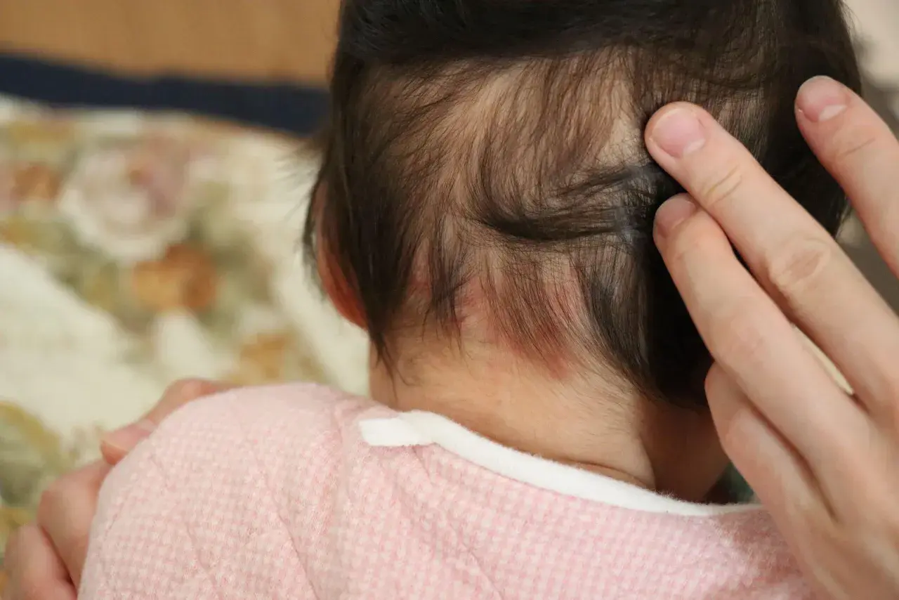 Piccolo bebè con macchie rosse sul collo, forse un morso della cicogna.