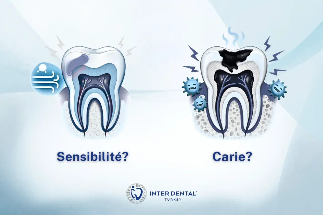 Dents saines vs. dent cariée. Si vous avez une sensibilité dentaire, que faire ? Consultez un dentiste.