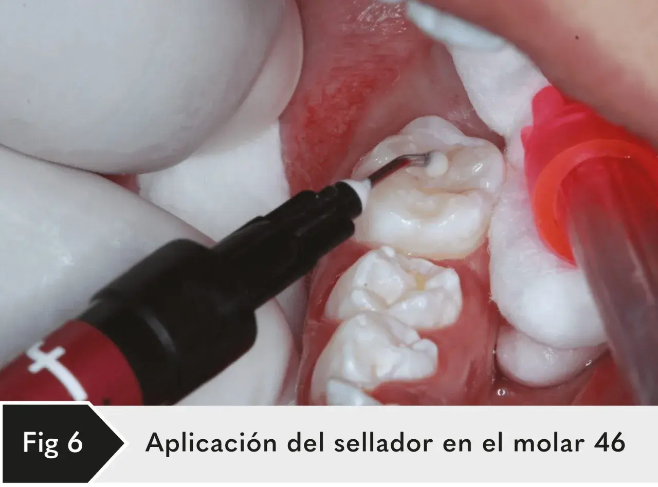 Aplicación de sellante dental en el molar 46. Un aplicador dental deposita el material en las fisuras del diente.