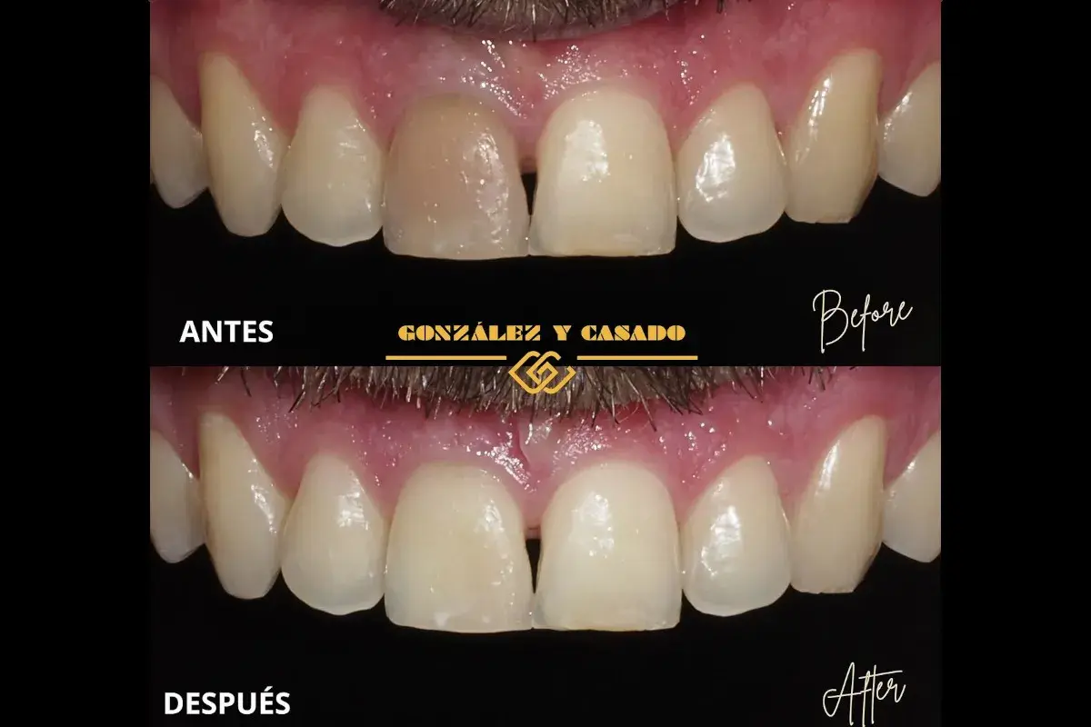 Antes y después de tratar un diente muerto. El diente oscuro se ha blanqueado y restaurado para que coincida con los demás.