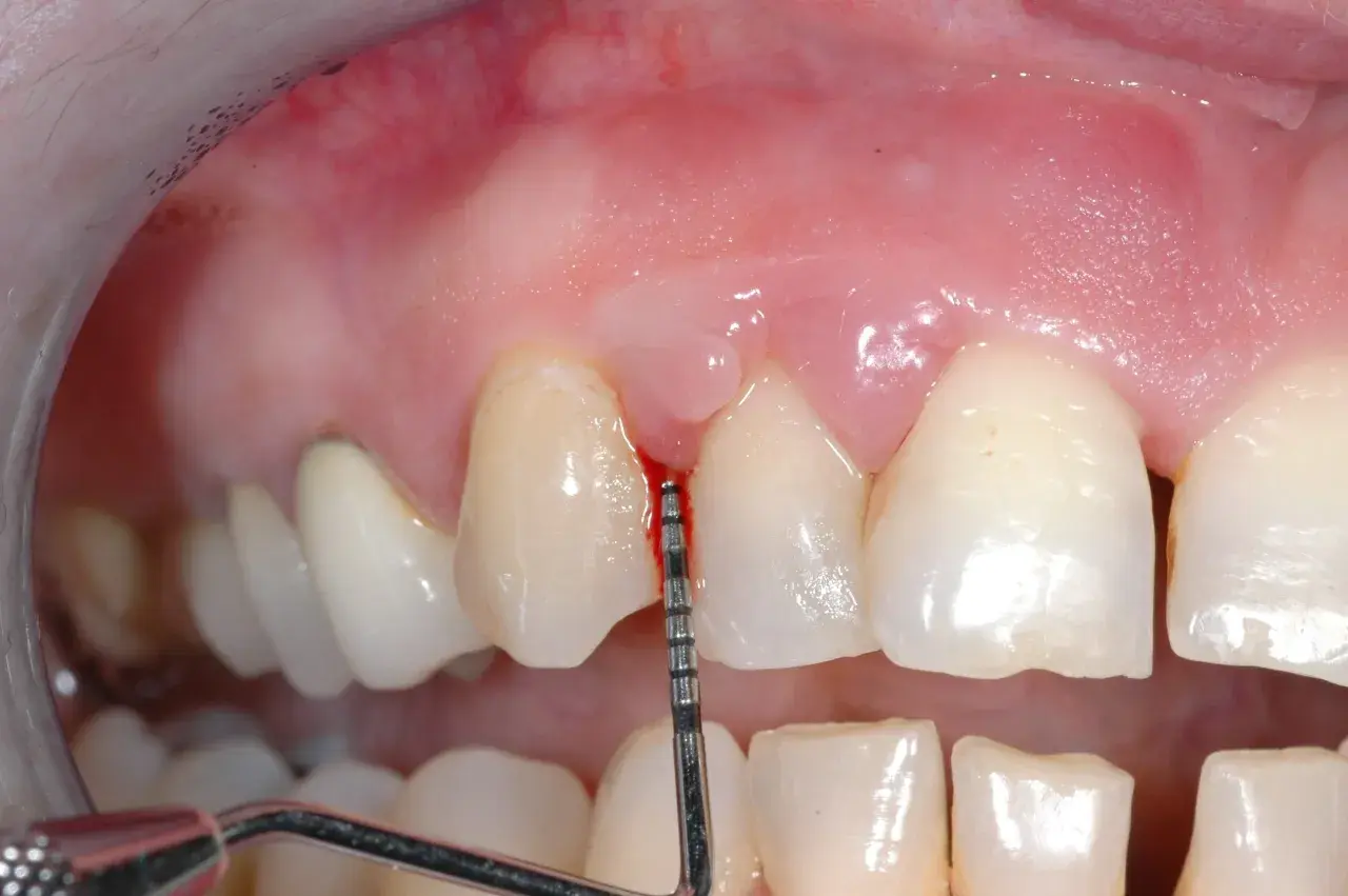 Strumento dentale misura la profondità gengivale. Alcuni credono che la pulizia dei denti rovina i denti, ma è fondamentale per la salute orale.
