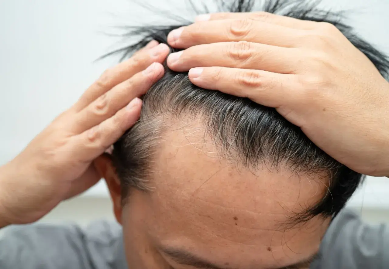 Man checking his hairline, concerned about thinning hair. This image can help you understand como saber si tengo alopecia.