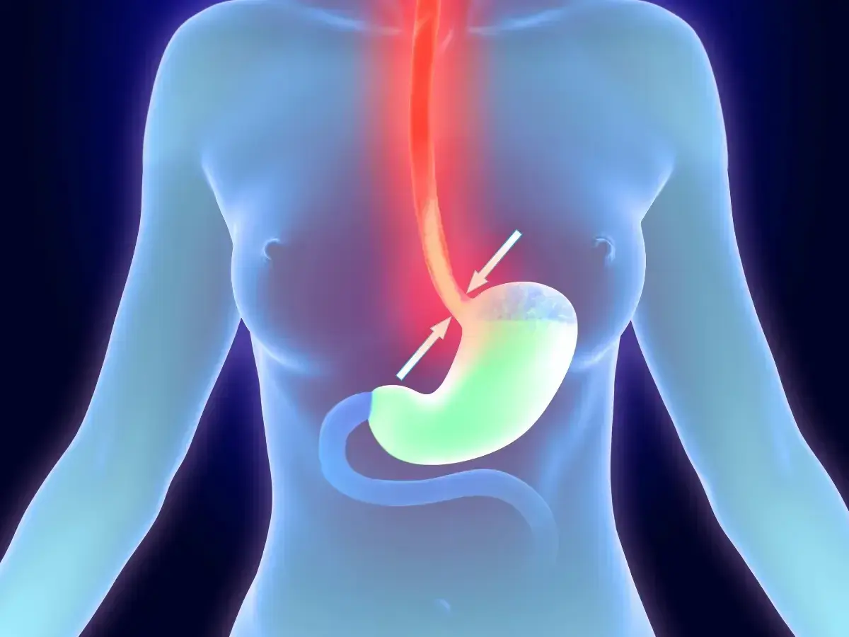 Illustrazione anatomica che mostra un esofago irritato e uno stomaco con reflusso, suggerendo ansia e strane sensazioni allo stomaco.