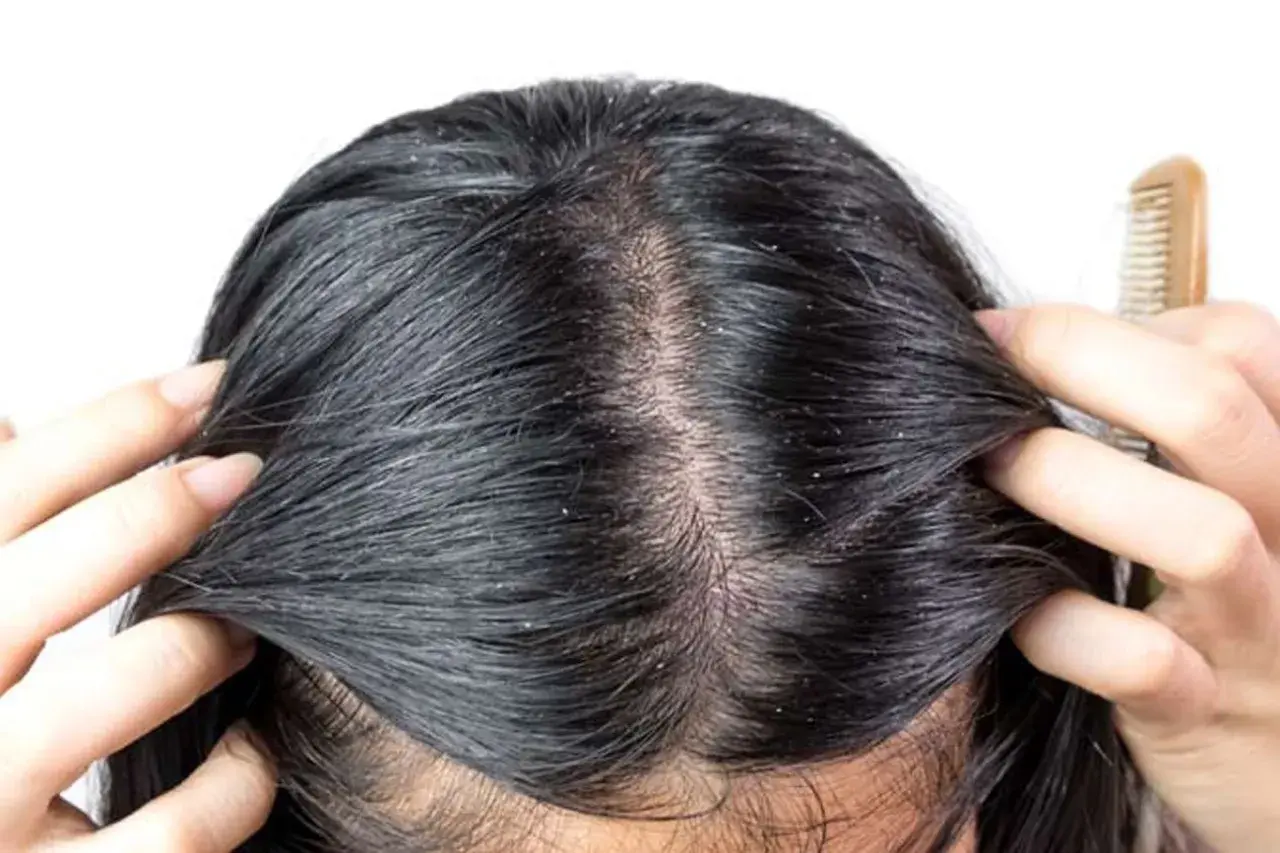 Cuoio capelluto con forfora visibile, sintomo comune della dermatite seborroica. Mani che separano i capelli scuri per mostrare le squame bianche.