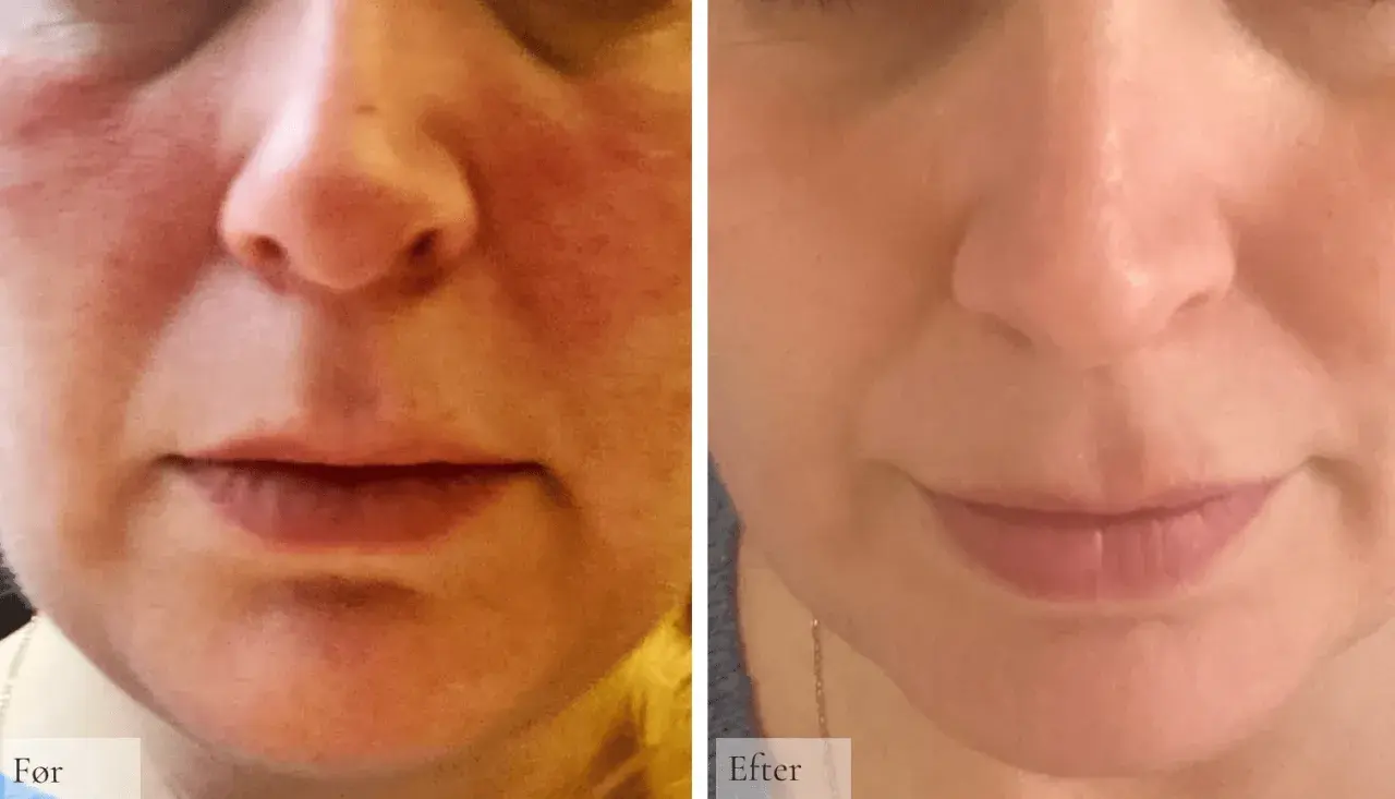 Före och efterbilder visar en minskning av rodnad och synliga blodkärl, vilket indikerar förbättrad rosacea hud.