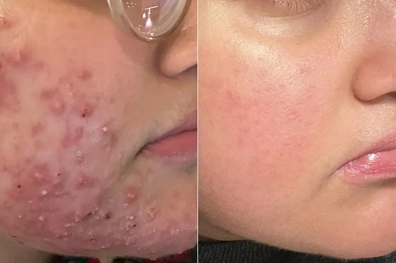 Före- och efterbilder visar ett ansikte med svår akne och rodnad, troligen orsakad av malassezia, som sedan blivit klarare och lugnare.