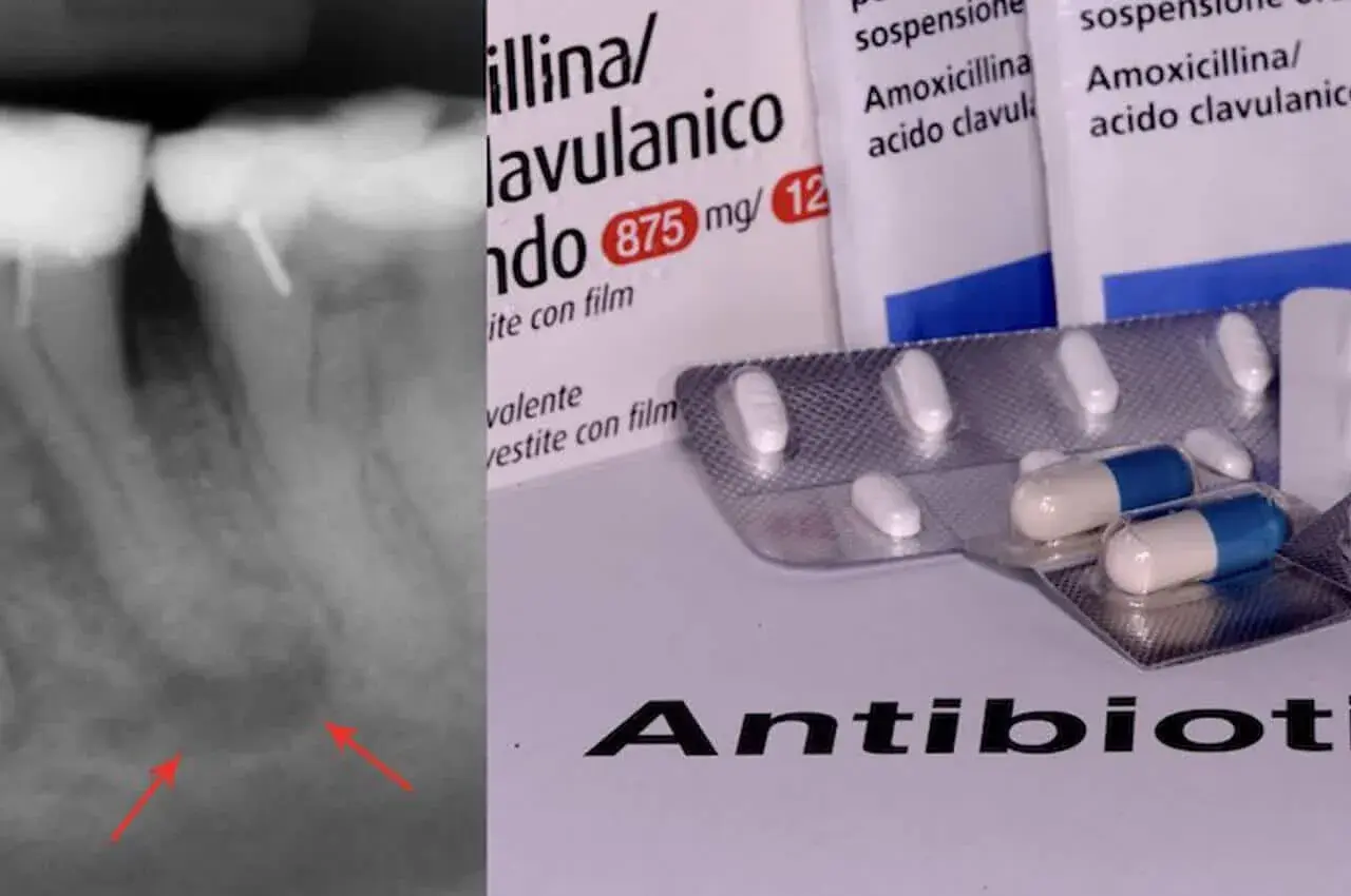 Radiografia di un ascesso dentale con confezioni di antibiotico amoxicillina/acido clavulanico.