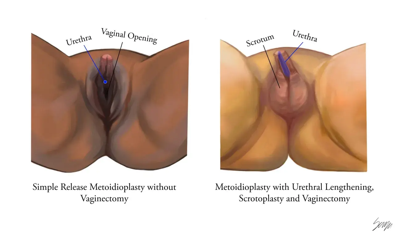 Comparaison de deux procédures chirurgicales pour transformer un pied mâle en femelle : la métoidioplastie simple et la métoidioplastie avec allongement urétral, scrotoplastie et vaginectomie.