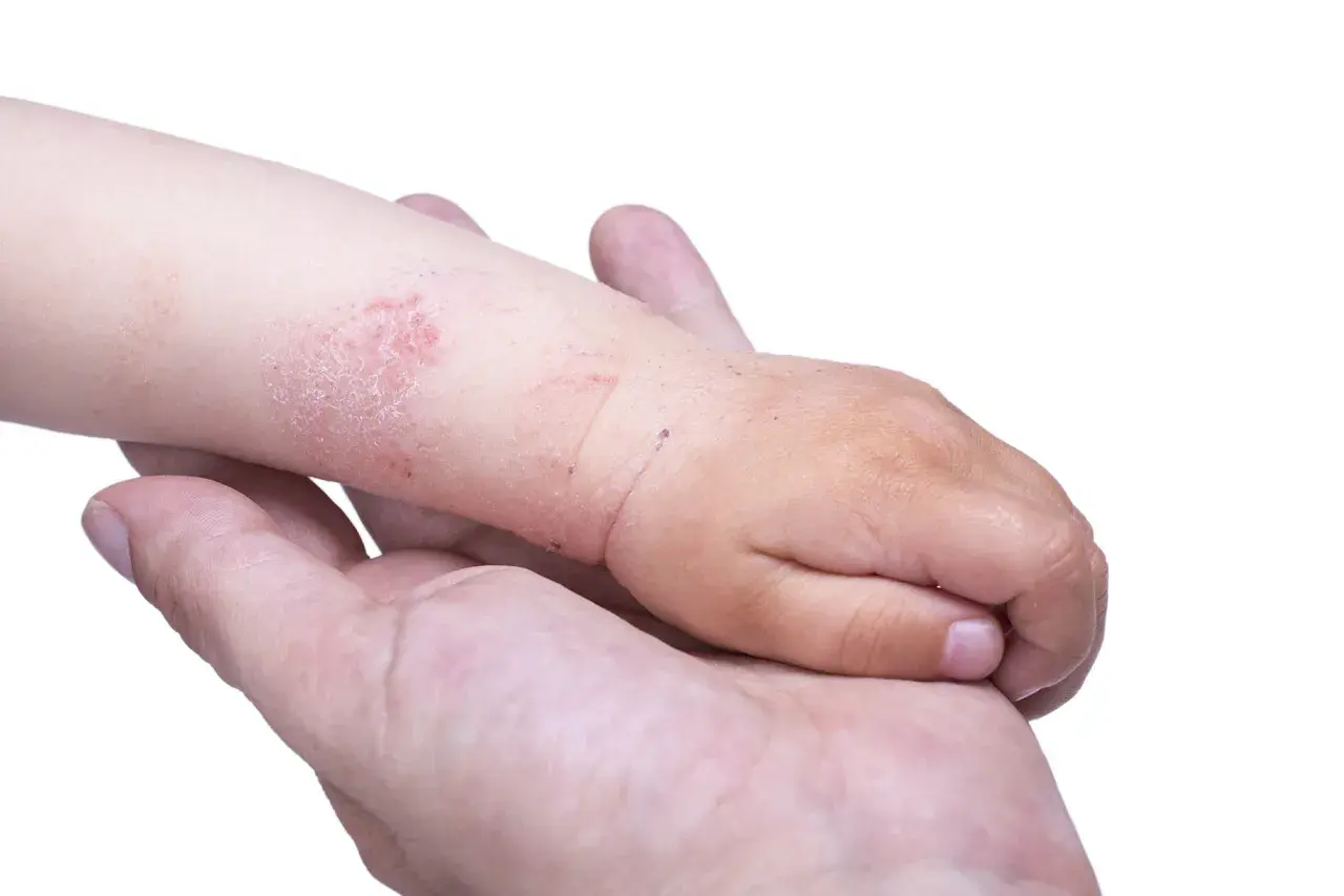 Mano di un adulto che tiene il braccio di un bambino con eczema. La pelle del bambino è arrossata e screpolata, mostrando i segni tipici dell'eczema nei bambini.