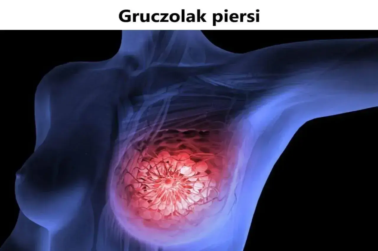 Schemat piersi z zaznaczonym gruczolakiem.