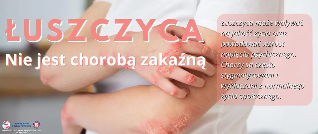 Łuszczyca na łokciach i dłoniach. Choroba nie jest zakaźna, ale wpływa na jakość życia i może prowadzić do napięcia psychicznego.