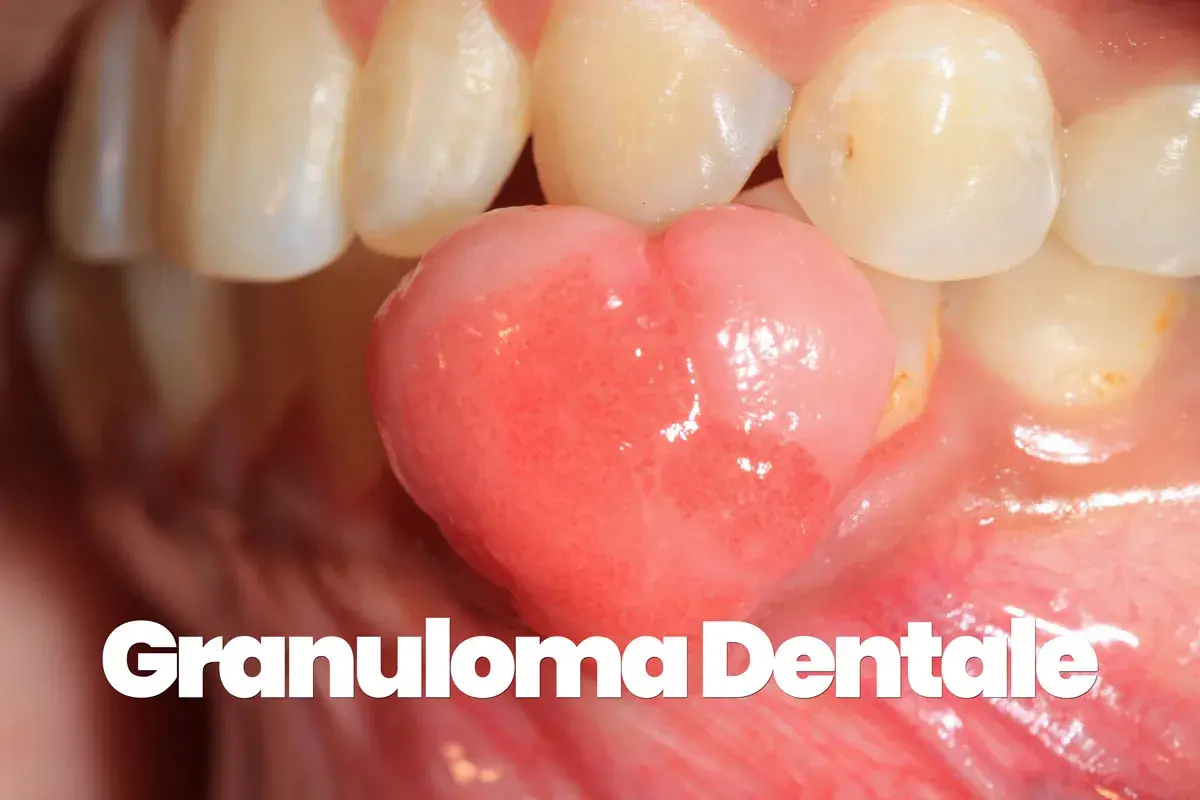 Un granuloma gengivale, una piccola protuberanza rosa, cresce tra i denti.