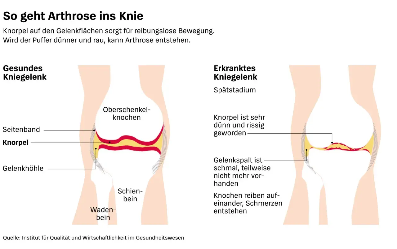 Vergleich von gesundem und arthrosekrankem Kniegelenk. Die Darstellung zeigt, wie Knorpelverschleiß zu Schmerzen führt – eine mögliche "wunderwaffe gegen arthrose knie" wäre hier wünschenswert.