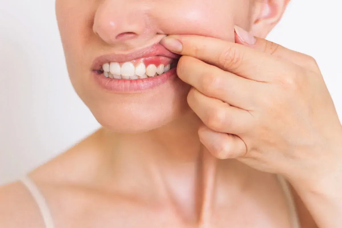 Donna mostra una gengiva gonfia e rossa, possibile conseguenza di una devitalizzazione dentale.