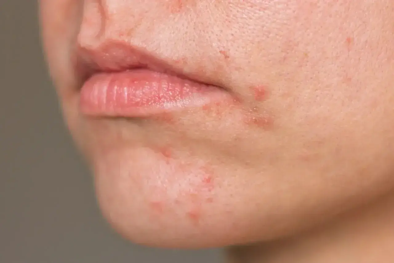 Haut um den Mund mit Rötungen und Pickelchen. Periorale dermatitis nulltherapie hilft nicht, die Haut ist gereizt.