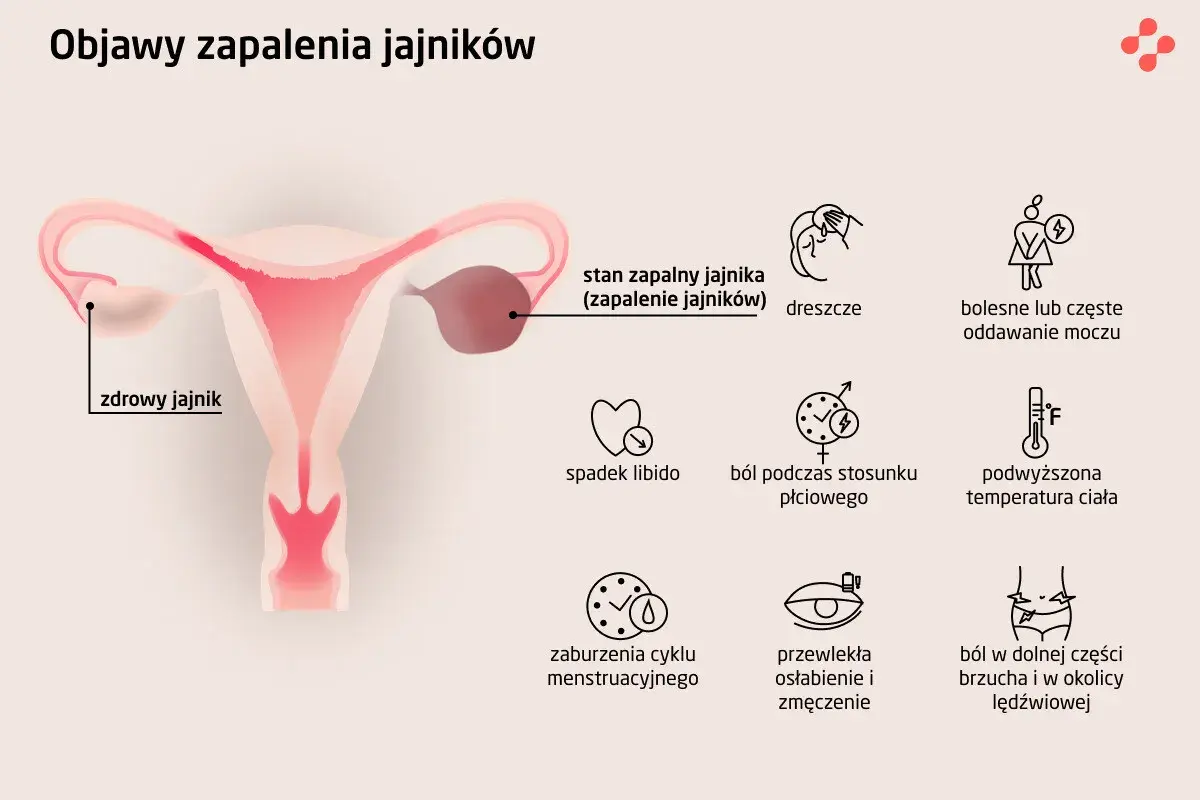 Ilustracja przedstawia budowę narządów rodnych kobiety z zaznaczonym zdrowym jajnikiem i stanem zapalnym jajnika. Wymienione objawy zapalenia jajników to m.in. ból brzucha.