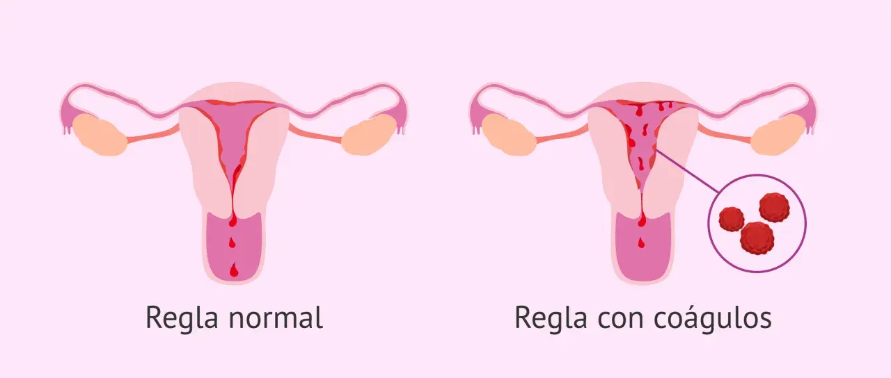 Comparación de úteros: uno muestra regla normal, el otro regla con coágulos. El embarazo y los coágulos menstruales son temas importantes.