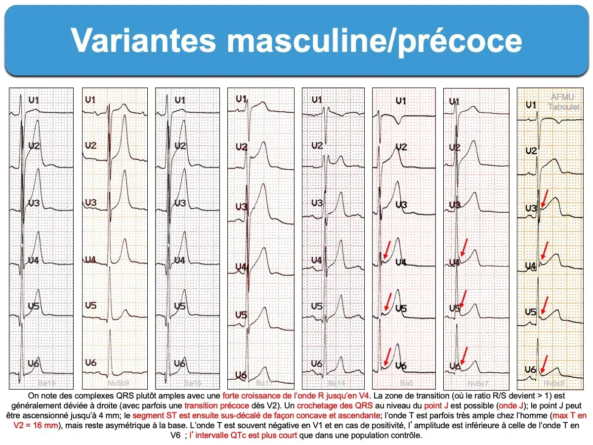 Variantes masculines/précoces : plusieurs tracés ECG montrant des variations de l'onde R et du segment ST, avec une transition précoce possible. Un ECG normal peut présenter ces caractéristiques.