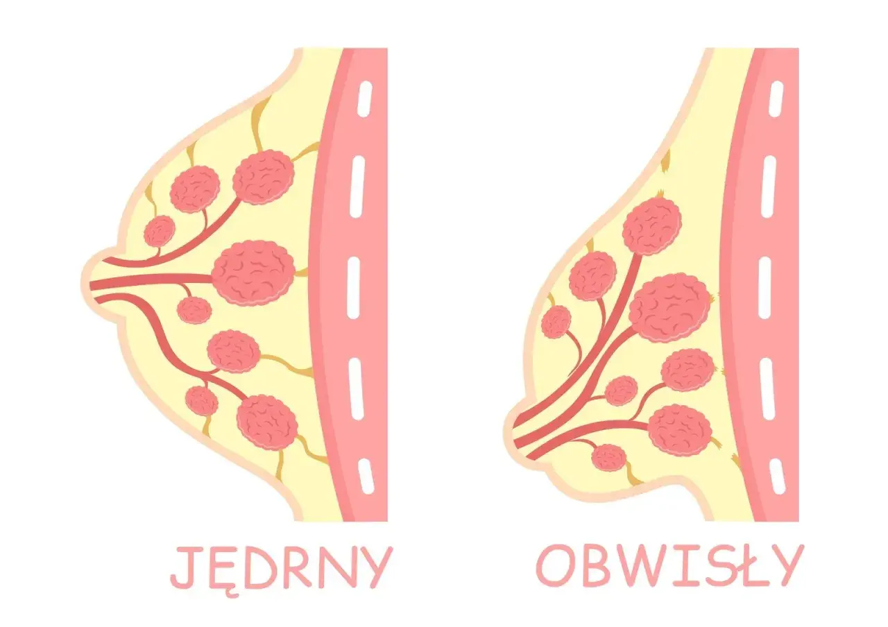 Ilustracja porównuje jędrny i obwisły biust, pokazując różnice w jego strukturze. Szukasz domowych sposobów na ujędrnienie biustu?