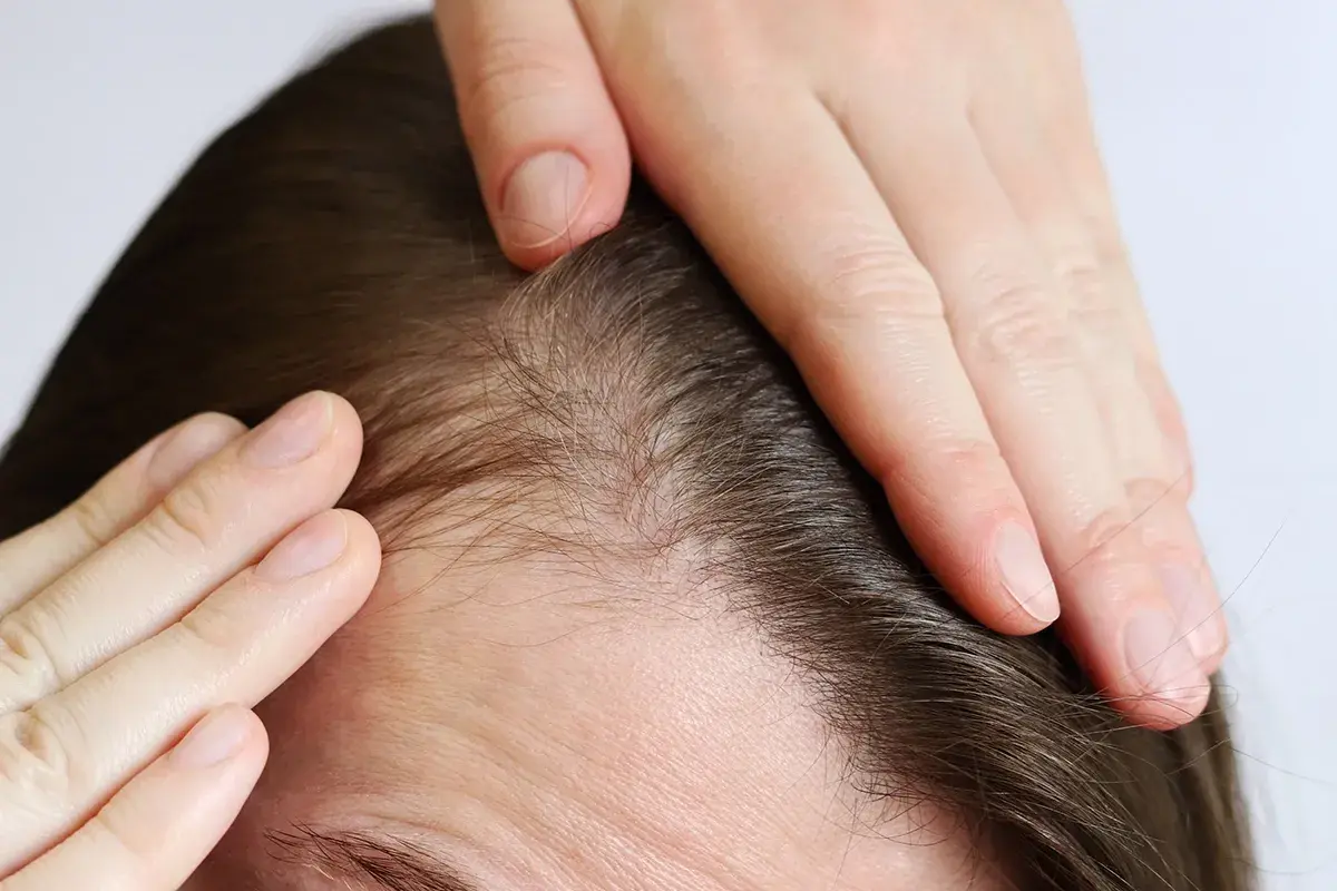 Manos revisan el cuero cabelludo, notando que me pica la cabeza y se me cae el pelo.