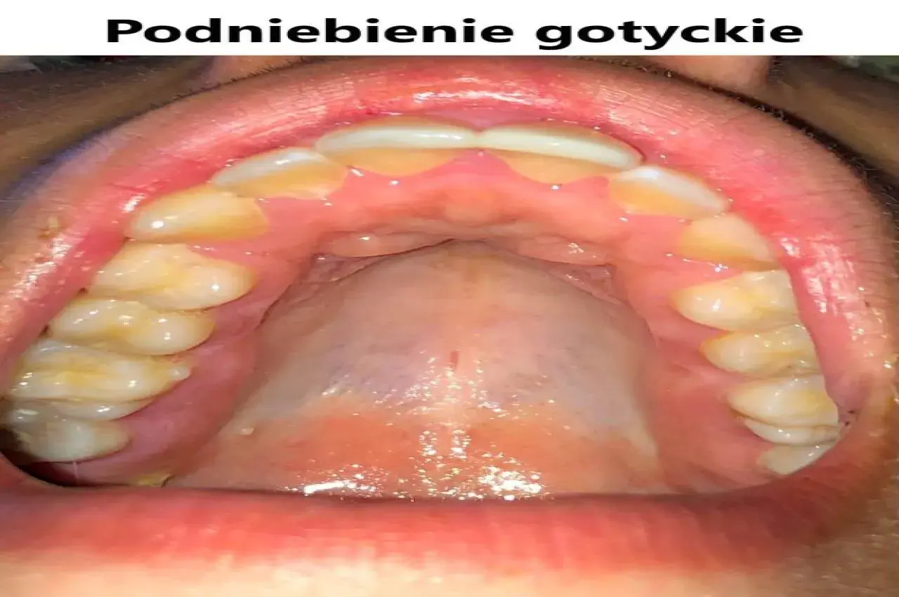Widok jamy ustnej z zębami i podniebieniem. Podniebienie gotyckie, zdrowe, z widocznymi zębami.