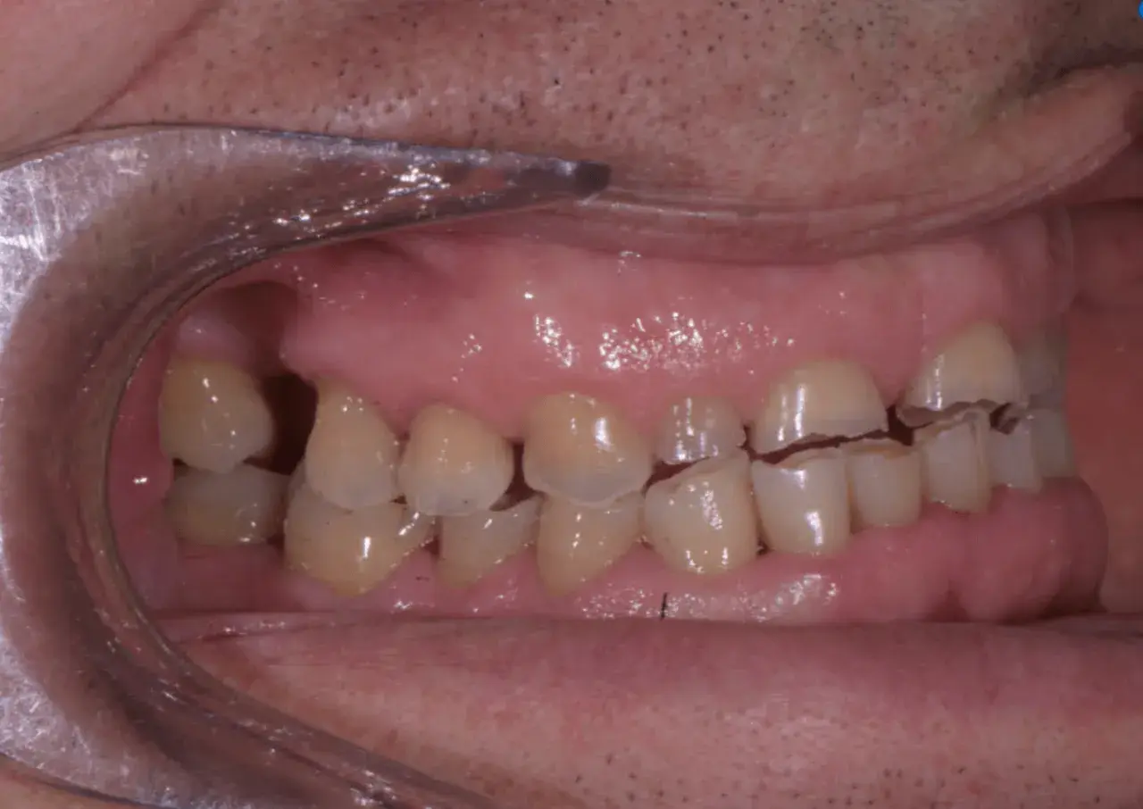 Denti con segni visibili di erosione dentale, con smalto consumato e bordi irregolari.