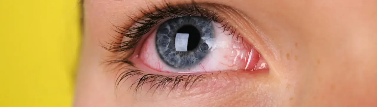 Occhio congiuntivite: arrossamento e secrezioni indicano possibili cause virali o batteriche.