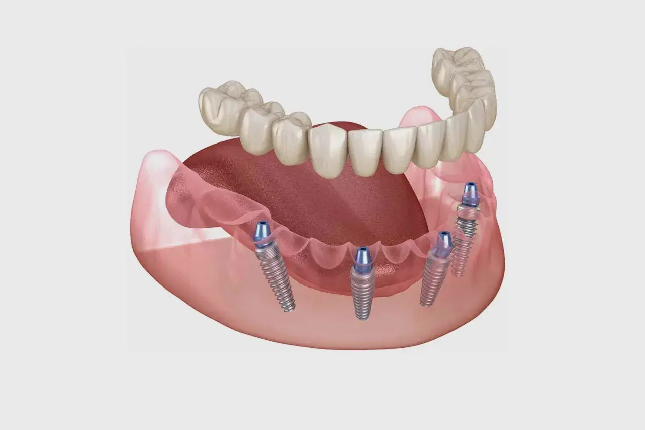 Immagine di protesi dentali fisse su impianti, una soluzione innovativa per chi cerca impianti dentali senza bucare osso.