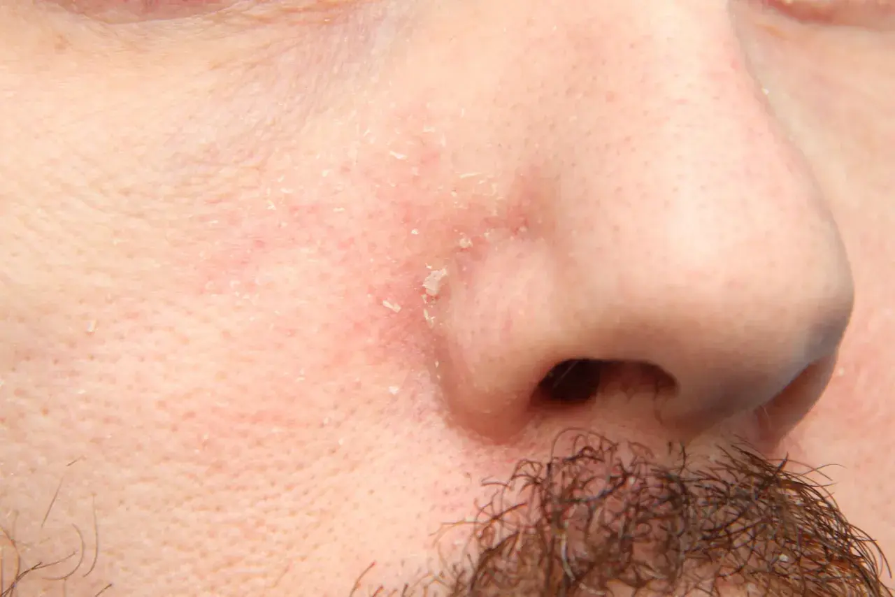 Piel enrojecida y escamosa alrededor de la nariz y la barba, indicativo de dermatitis seborreica barba.