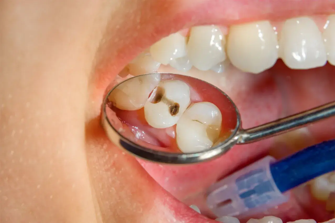 Specchio dentale riflette due denti con evidenti carie. Un dente ha una cavità scura, l'altro mostra un'area danneggiata.