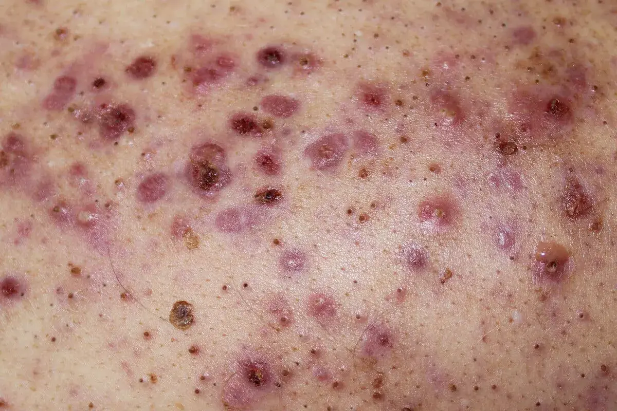 Piel con múltiples pápulas, pústulas y nódulos inflamados, característicos del acne conglobata.