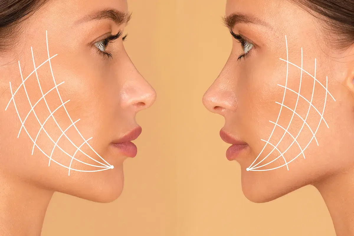 Dos perfiles de mujer con líneas blancas que simulan el efecto de un tratamiento facial. El antes y después de Thermage FLX para una piel más firme.