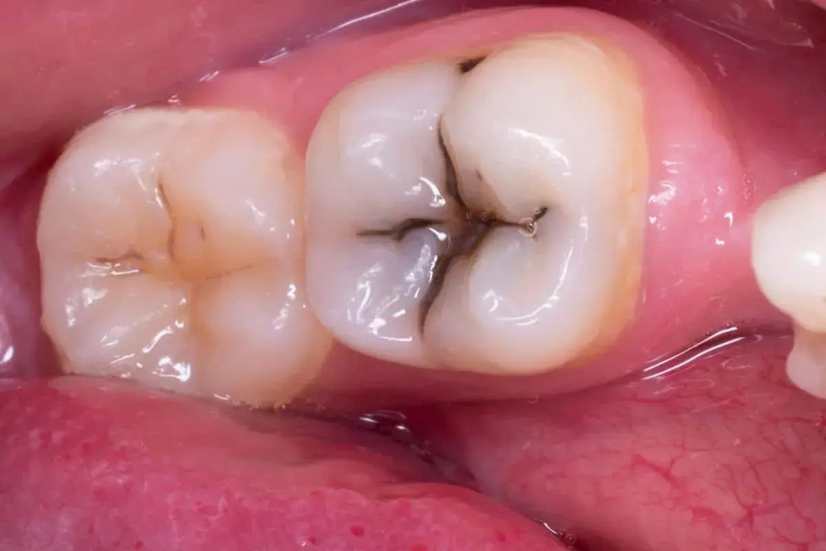 Dente con carie profonda che necessita di cure. La cavità scura è ben visibile nella fessura centrale.
