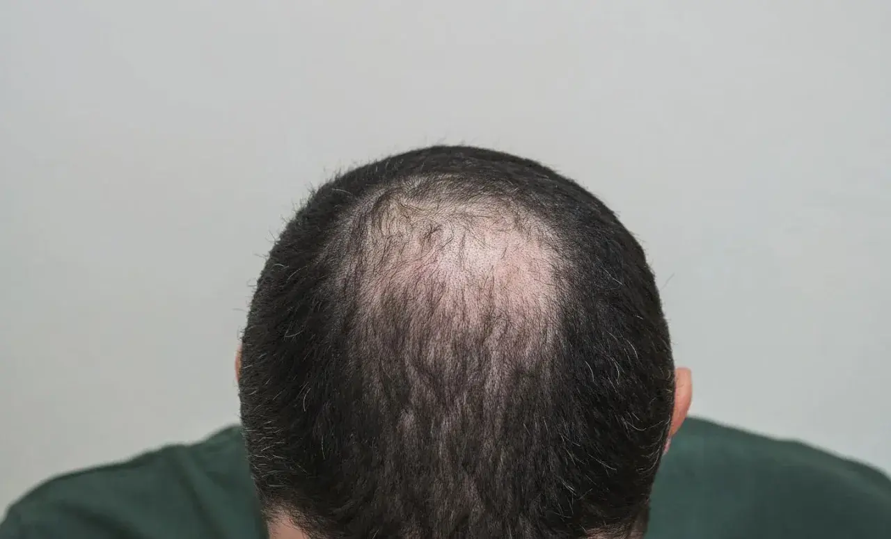 Vista superior de la cabeza de un hombre mostrando la pérdida de cabello, un ejemplo de alopecia androgénica que es común.
