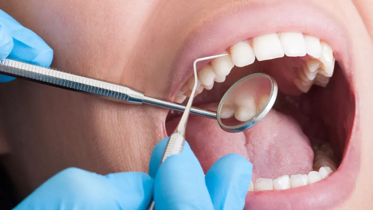 Bocca aperta con strumenti dentistici. La pulizia dei denti fa male? Forse, ma necessaria per un sorriso smagliante.