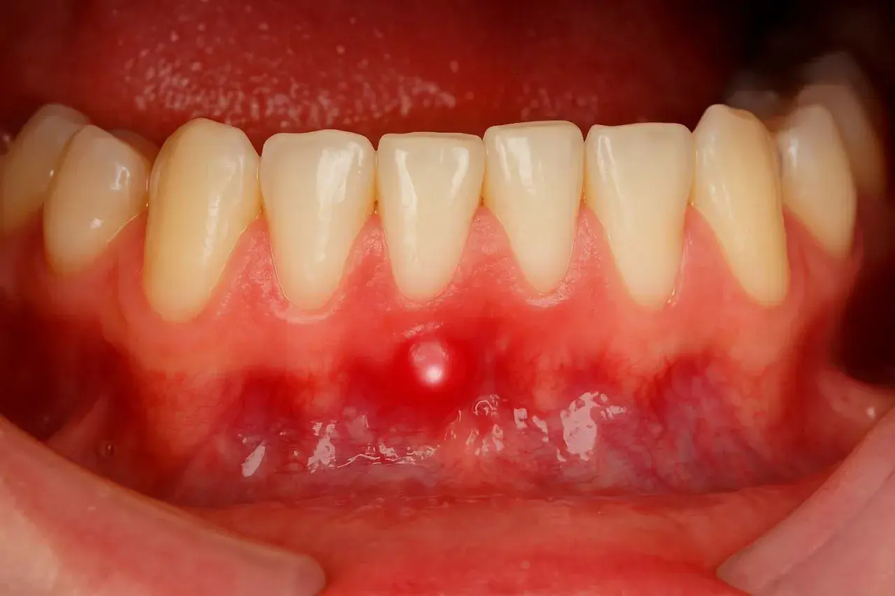 Una piccola bolla sulla gengiva, rossa e gonfia, vicino ai denti inferiori.