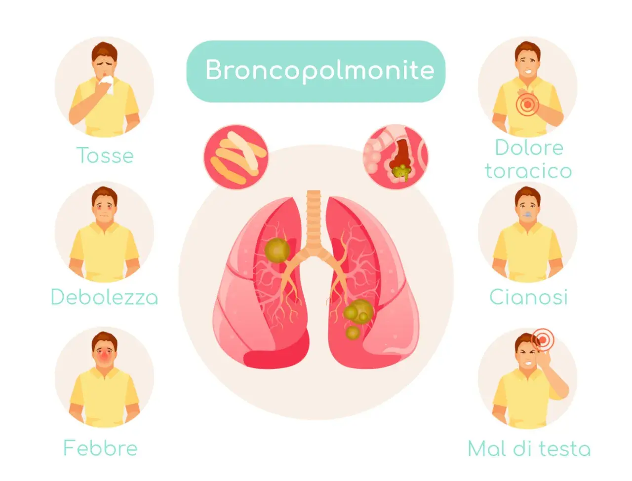 Illustrazione dei sintomi della broncopolmonite: tosse, debolezza, febbre, dolore toracico, cianosi e mal di testa.