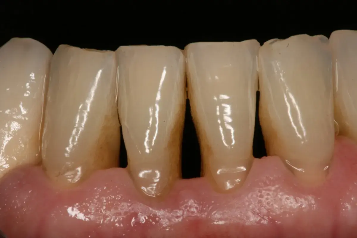 Dientes con acumulación de sarro y encías inflamadas, signos de periodontitis causas.