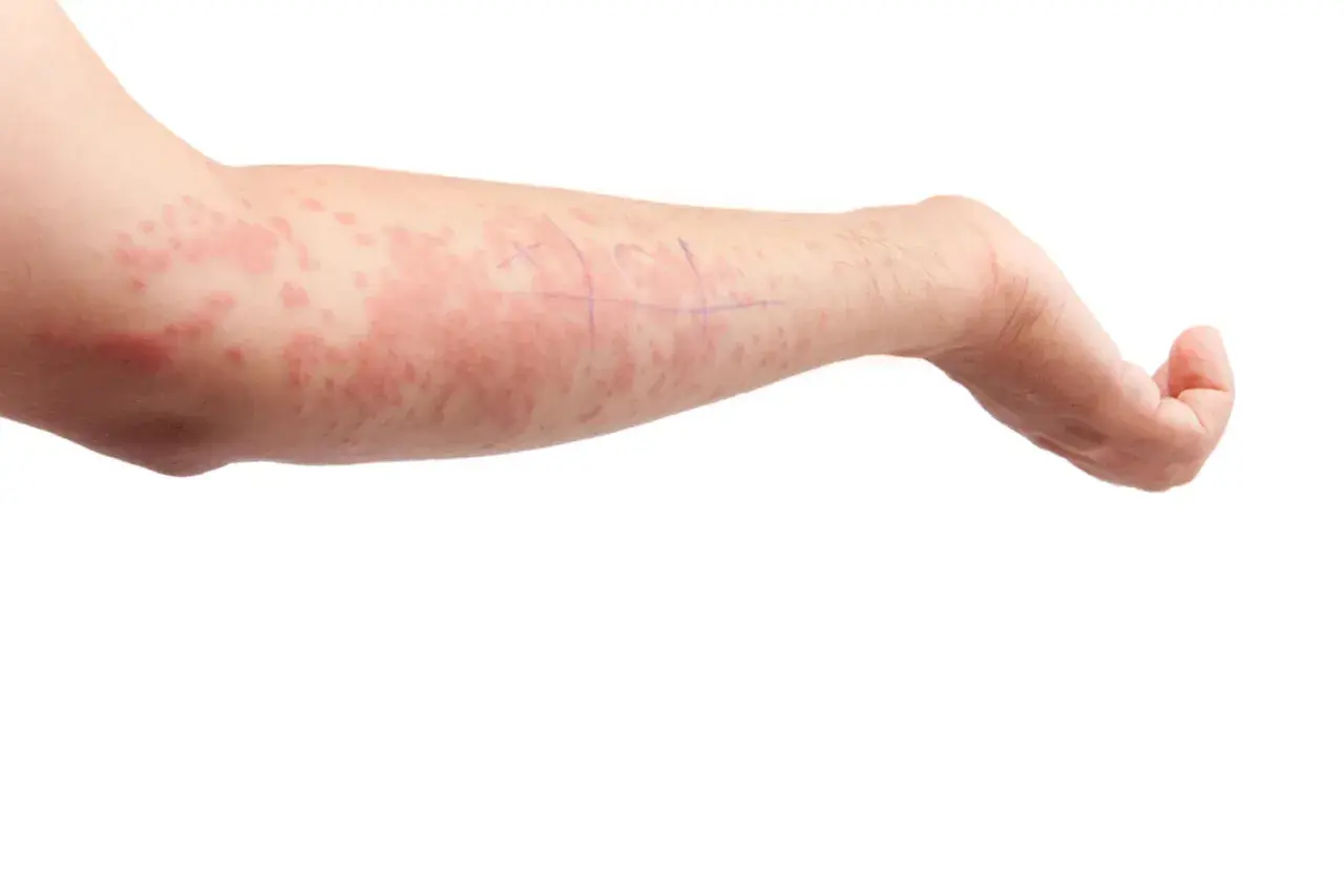 Braccio di un bambino con eruzioni cutanee rosse e pruriginose, indicative di orticaria neonato. Segni viola indicano aree di test.