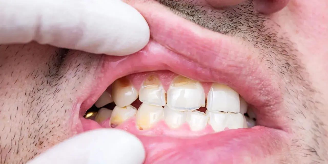 Dientes con manchas y aspecto desgastado, sugiriendo hipoplasia dental.