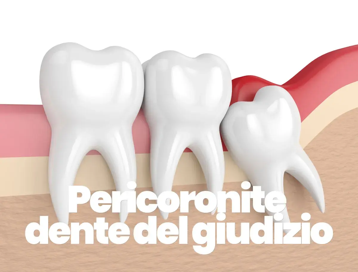 Dente del giudizio parzialmente coperto dalla gengiva, causa di pericoronite.